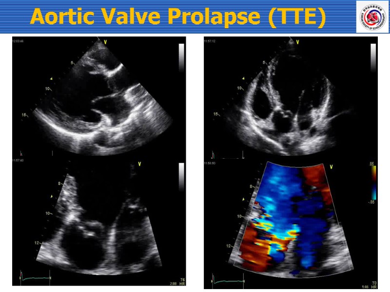 Aortic Valve Prolapse (TTE)